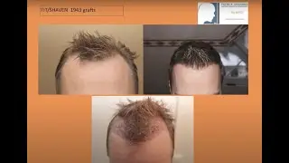 Haartransplantation Geheimratsecken Vorher Nachher | Dense Packing | Experte Dr. Patrick Mwamba