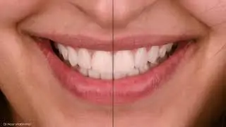 The Concept Of Digital Smile Design And How To Do It. Dr. Nour Marshaha