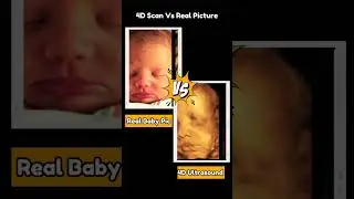 4D Baby Scan Vs Real Life 😍💯 #baby #ultrasound #real