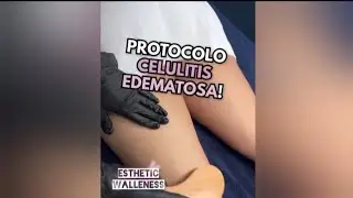 Celulitis Edematosa: Tratamiento No Invasivo