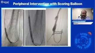 Tri wedge Webinar Part 1  Opening & Dr  Saravana & Discussion Case Sharing of Tri wedge Used in AVF