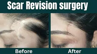 Scar revision surgery - 6 month follow up result| Scar revision surgery in Ranchi #scar #mark