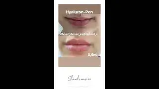 Hyaluron-Pen