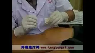 Professor Steven Woo of O.G Pain Clinic treating Ankylosing Spondylitis with Acupotomy.