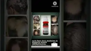 acid fluor miracle in alopecia areata  #shortvideo #ytshorts #ytstudio #shortsfeed #shortfeed