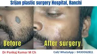 Birthmark Removal| Birthmark Removal with surgery + laser treatment by Dr Pankaj Kumar