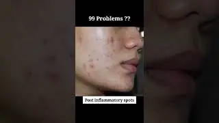 99 Problems ka only 1 solution| Bioderma Pigmentbio Foaming Cream #skincaretips #selfcare #skincare