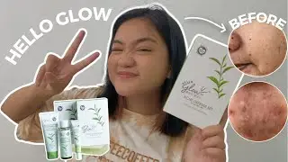1 WEEK REVIEW OF HELLO GLOW ACNE DEFENSE SET (Ingredients, experience and how I use it)