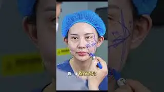 #fyp #facelift #midfacelift  #cheeklift #fullfacelift #threadlift #raceliftmalaysia #angkatmuka
