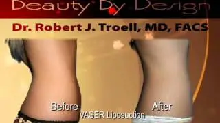 VASER Shape and VASER Liposuction with Dr. Robert Troell