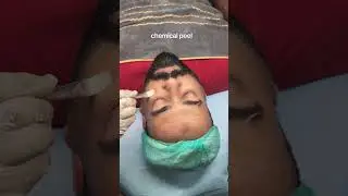 funny chat during chemical peel. #chemicalpeel #glycolicacid #lacticacid #TCA #sohnaaesthetics