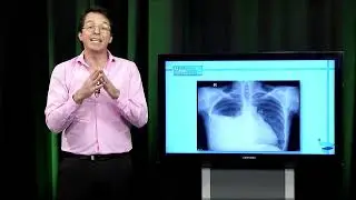 Derrame pleural. Porque se produce y como tratarlo.
