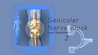 Genicular nerve block by Dr Murli Krishna, Pain Specialist Bristol
