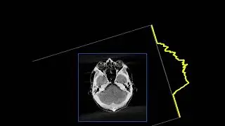 Filtered back-projection reconstruction of a head slice