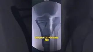 Emergency OT #proximal tibia #aiims #aiimsraipur #raipur #chhattisgarh #orthopedics
