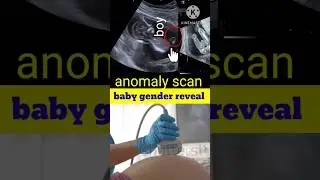 anomaly scan ultrasound। Gender Reveal #shortsvideo  #ytshorts #pregnant #ultrasound #genderreveal