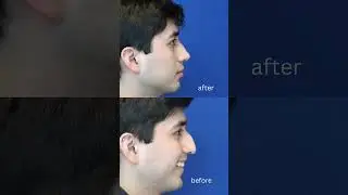 Amazing Rhinoplasty Magic with Dr. Ali Sajjadian | Natural looking Nose!