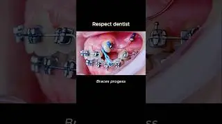 Braces as magic. Respect the dentist #braces #dentist #orthodontist