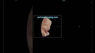 3D Ultrasound #jerbearimaging #3dultrasound #baby #inhomeultrasound