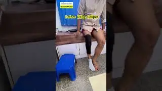KAFO#calipers #prostheticsandorthotics #ossur #prostheticlimb #naklitang