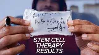 Real Results After BioXcellerator Stem Cell Therapy