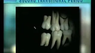 Clip 19: Eruption of Second Permanent Molars