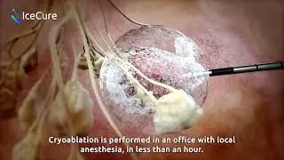 IceCure Medical's ProSense Cryoablation System