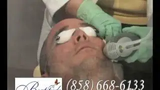 Acne Treatment San Diego