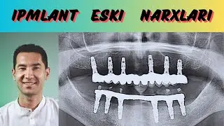 Implant narxi Va qo'yilish tartibi? // Urganch 2023