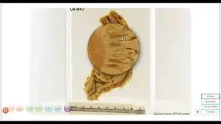 Oesophageal cancer Morbid specimen discussion- NUS virtual pot