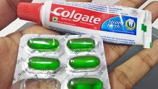 Natural Beauty Hacks For Remove Pimples Overnight | Vitamin E Capsule Colgate Toothpaste Beauty tips