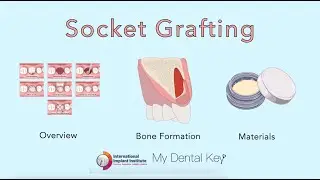 Трансплантация альвеолярного отростка &mdash; обзор, предпосылки, материалы | My Dental Key x Междунаро...