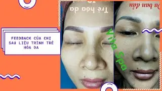 Feedback Của Chị Sau Liệu Tr&igrave;nh Trẻ H&oacute;a Da Tại #VitaSpa