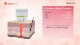 HIFU Ultraskin, principe des ultrasons focalis&eacute;s