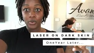 Laser Hair Removal on Dark Skin Black People | Hyperpigmentation RECOVERY!