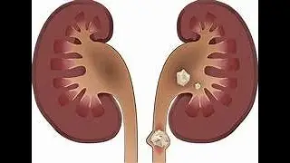 La colique n&eacute;phr&eacute;tique : pathologies m&eacute;dicales