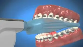 #1 AcceleDent Video with Braces.wmv