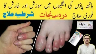 Sardi Ma Hathon Paon Ki Sujan Ka Ilaj | fingers swelling in winter @MSulemanTech
