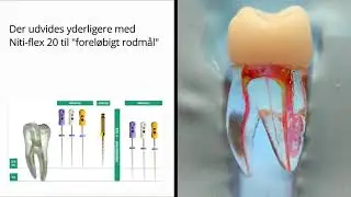 Traditional glidepath management with K-flex and x-ray calibration
