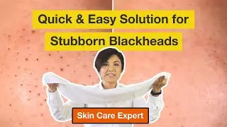No more blackheads with Hot towel remedy | Simple Skincare | Sunny Advanced Skincare Tips
