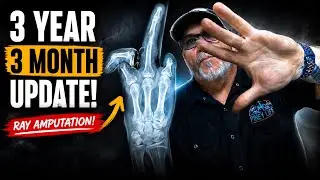 Ray amputation 3 years after the accident!