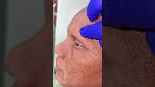 Alopecia Universalis Treatment