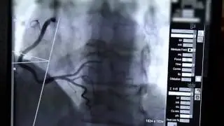 A Stent in Time Saves Lives