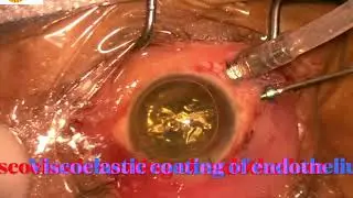 AIOC2024 - VT510 - Dr.Meenakshi Mahesh - Back from the point of no return- The Extreme Retina