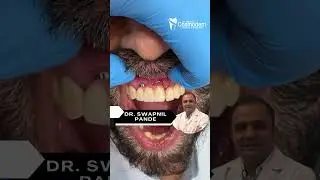 Missing Front Teeth Get Fixed Teeth in 3 Days!  by Dr  Swapnil Pande  Very Affordable Cost in Mumb