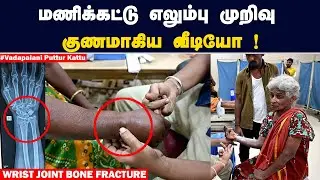 மணிக்கட்டு எலும்பு முறிவு குணமாகிய வீடியோ ! Wrist Joint Fracture | CHENNAI BANGALORE PUTTUR KATTU