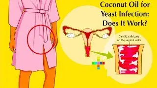 How to Use Coconut Oil for Yeast Infection Naturally and Quickly ❤ Home Remedies for Yeast Infection