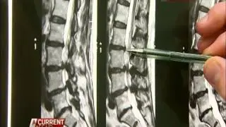 Back pain breakthrough