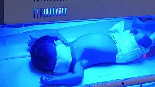 Neonatal Jaundice Baby Treatment | NICU Phototherapy Care 💡.