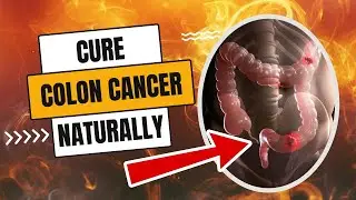 How To Cure Colon Cancer Naturally | Fit&Fab